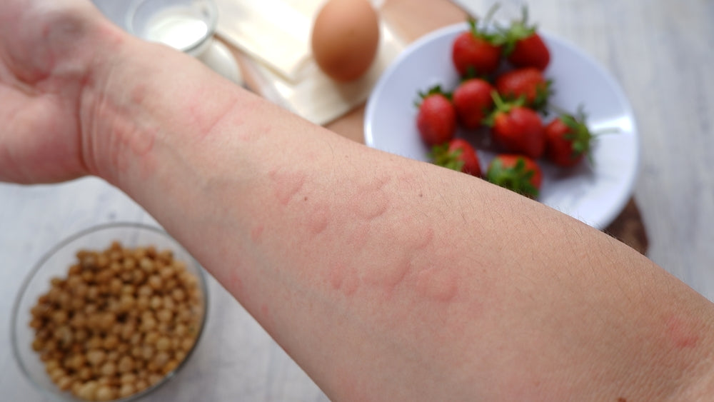 A close-up of a person's arm shows raised, red welts, indicating an allergic reaction, with a bowl of soybeans, strawberries, an egg, and milk in the background, suggesting food allergy concerns.