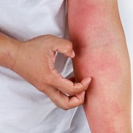 A person is scratching a red, irritated area on their arm, indicating a possible allergic reaction or skin irritation.