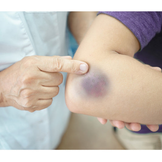 A healthcare professional points to a mysterious bruise on a patient's elbow, suggesting a potential deficiency while standing in a clinical setting.