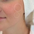 Patch anti-boutons tailles multiples – 105 patchs hydrocolloïdes en 5 tailles avec huile d'arbre à thé