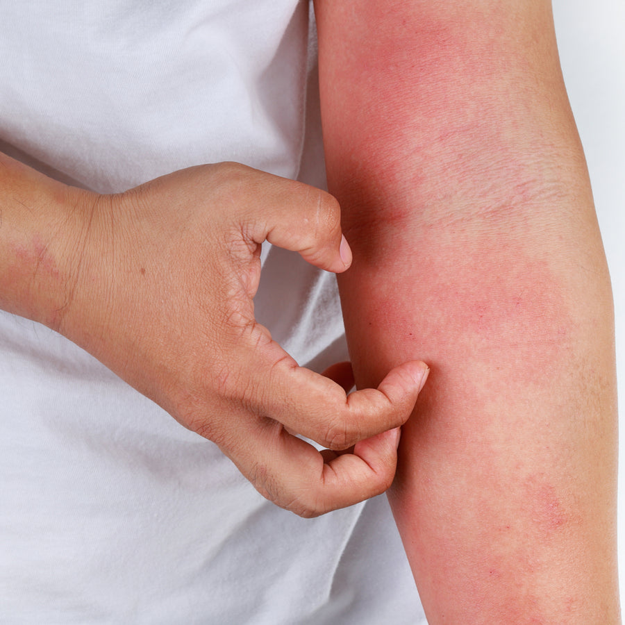 A person is scratching a red, irritated area on their arm, indicating a possible allergic reaction or skin irritation.