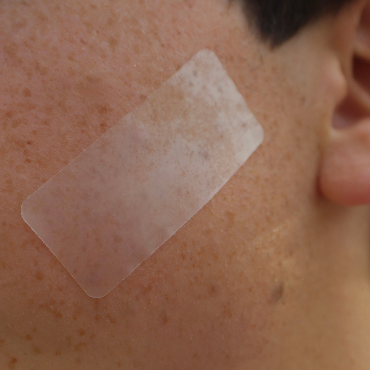 Pimple Patch XL – 10 Extra-Large Hydrocolloid Patches for Face and Body