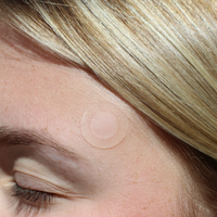 Microneedle Blemish Patch – 9 Patches with Salicylic Acid and Tea Tree Oil