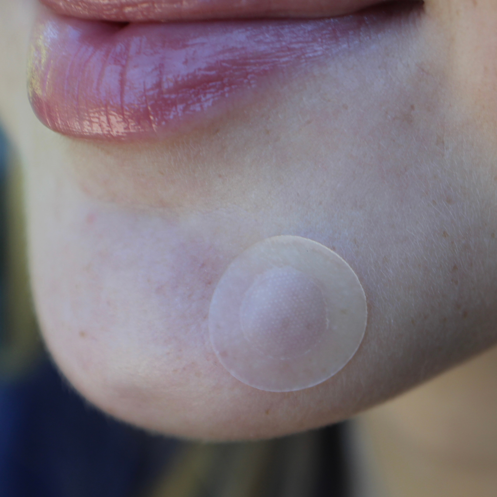 Microneedle Blemish Patch – 9 Patches with Salicylic Acid and Tea Tree Oil