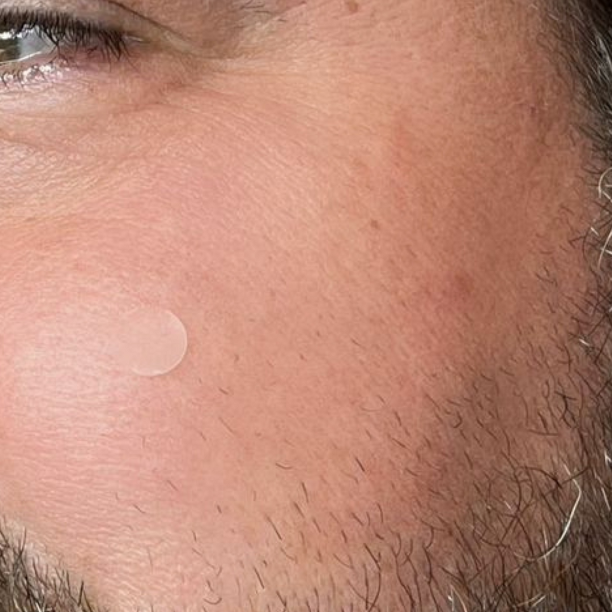 Pimple Patch Multi-Size Pack – 105 Hydrocolloid Patches in 5 Sizes with Tea Tree Oil